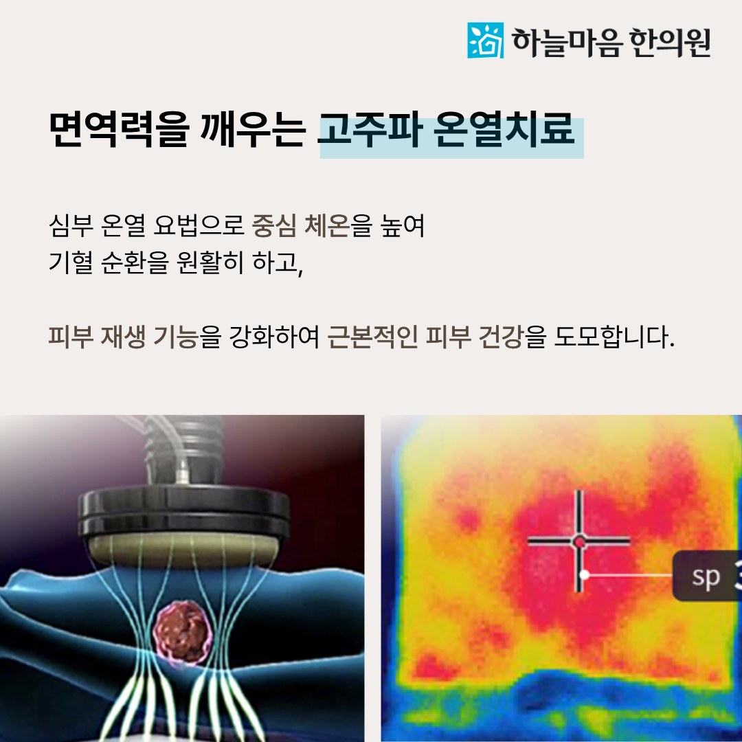 하늘마음한의원 청주점 고주파 온열치료